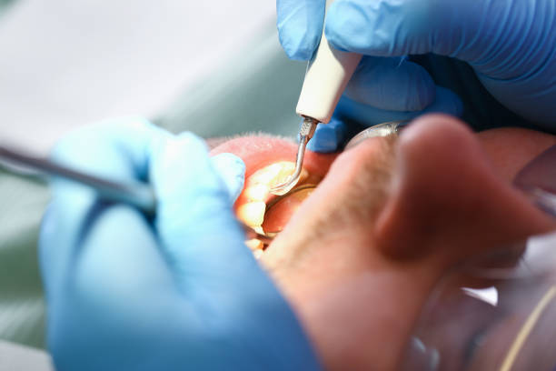 Best Broken or Cracked Tooth Emergency Dentist in Port Dickinson, NY