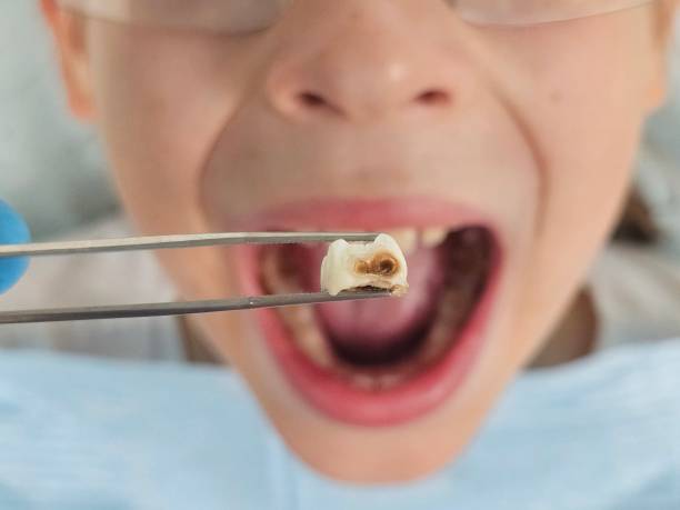 Best Urgent Dental Care for Toothache in Port Dickinson, NY